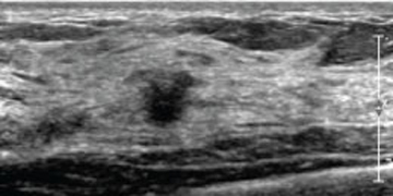 Second Look Ultrasonográfico